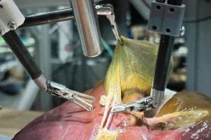 The Surgical Robot Transformer-Hierarchy performing a gallbladder surgery